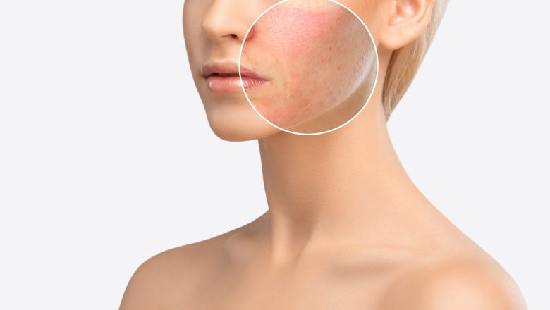 The treatment to solve the acne
